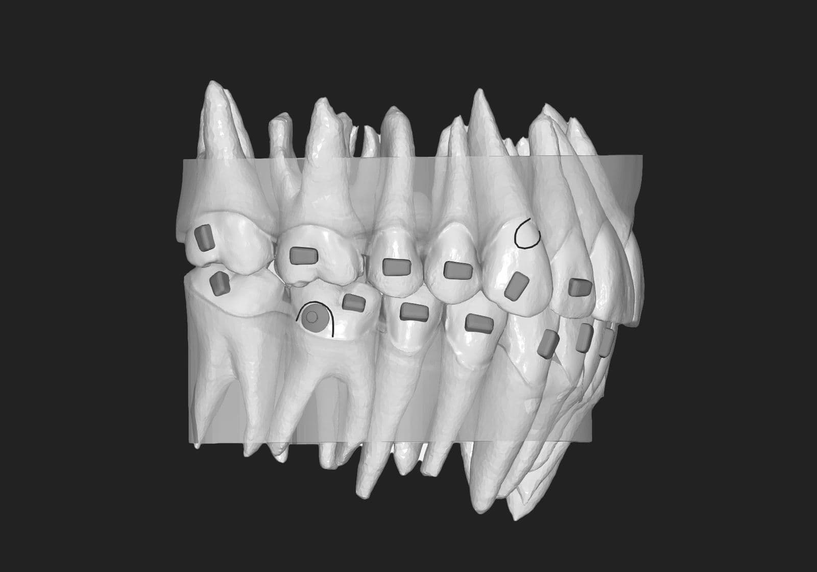 Dental scan showing teeth alignment